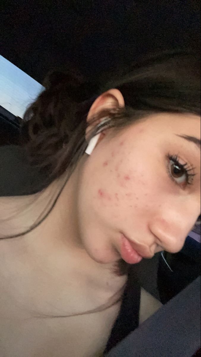 acne-💋
